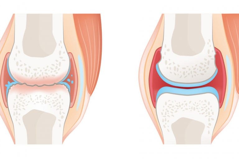 علامات التهاب المفاصل