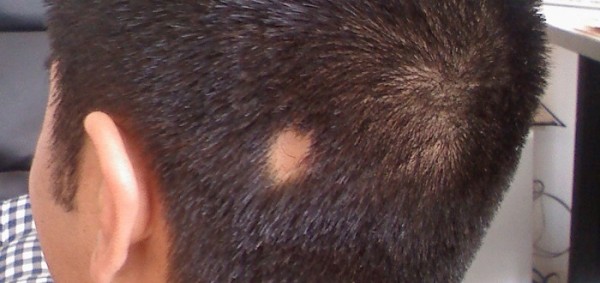 هل الثعلبة معدية