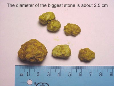 مقاسات حصوات المرارة وانواعها بالصور