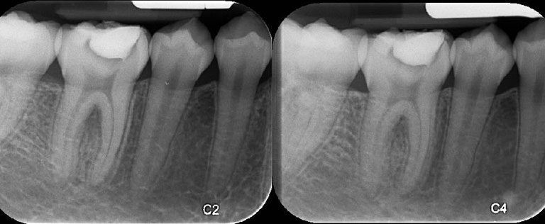 كيفية تسكين الم الضرس