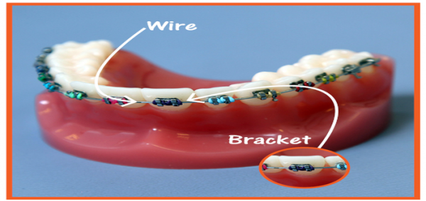 مراحل تقويم الأسنان