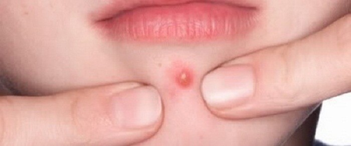 متى يحتاج الدمل إلى جراحة