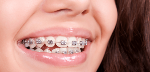 ما هي مدة تقويم الاسنان