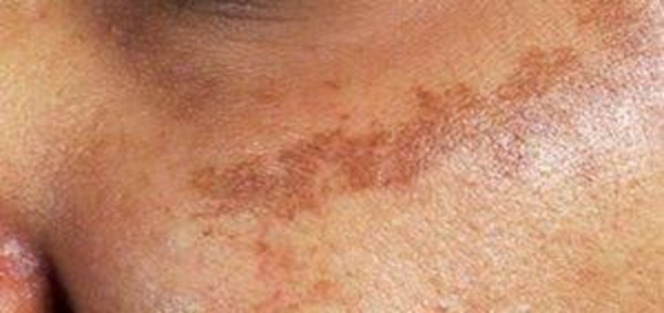 كيف أزيل الكلف نهائيًا