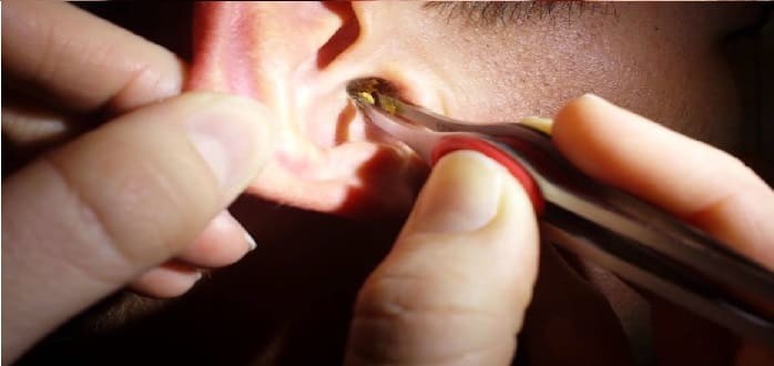 أفضل طريقة لتنظيف شمع الأذن