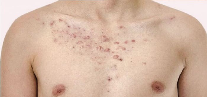 طرق التخلص من حبوب الشباب في الصدر طرق التخلص من حبوب الشباب في الصدر