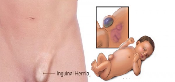 الفتق الاربي عند الرضع