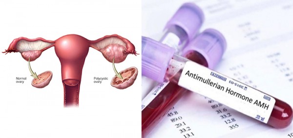 تكيسات المبايض ودورها في ضعف مخزون المبيض