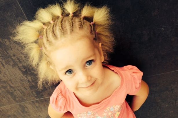 متلازمة الشعر غير القابل للتمشيط