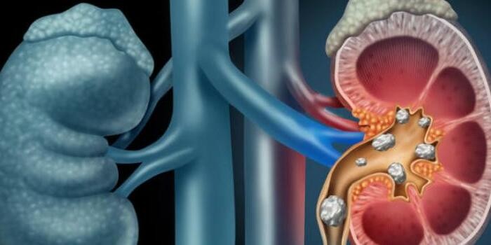 انواع حصوات المسالك البولية