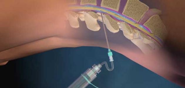 تحليل عينة النخاع