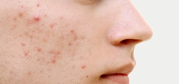 انواع حب الشباب