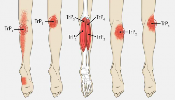 متلازمة تململ الساقين متلازمة تململ الساقين