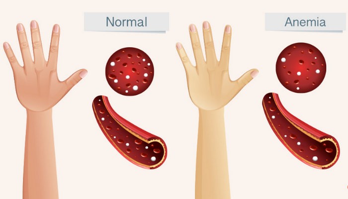 17 علامة تدل على نقص الحديد