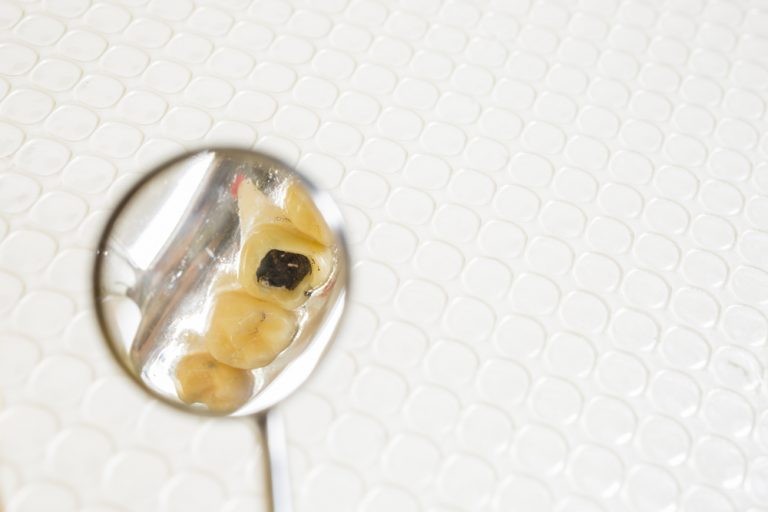 لماذا يحدث تسوس الأسنان بالرغم من تنظيفها ؟