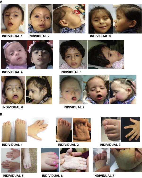 ما الجين الذي يسبب تشوهات خلقية عند الأطفال