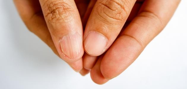 ما سبب تغير شكل الأظافر