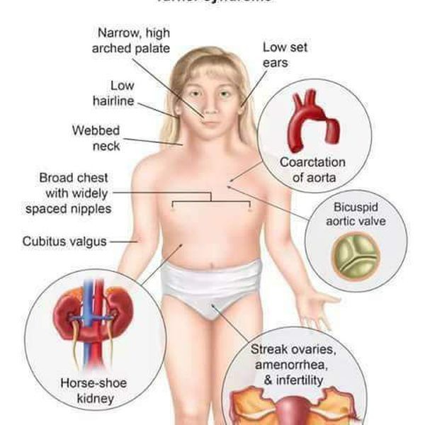 متلازمة تيرنر