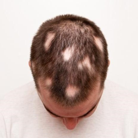 أسباب الثعلبة