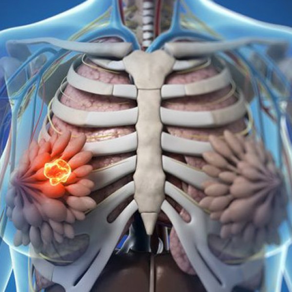 تليف الثدي .. أسبابه وعلاجه