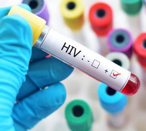 أعراض الايدز