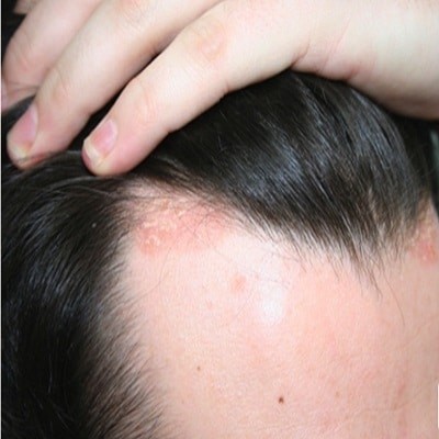 الاكزيما الدهنية