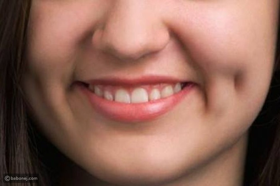 خطوات جراحة غمازة الوجه خطوات جراحة غمازة الوجه
