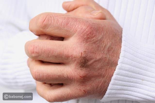 علاقة مرض السكري وتأثيره على الجلد علاقة مرض السكري وتأثيره على الجلد