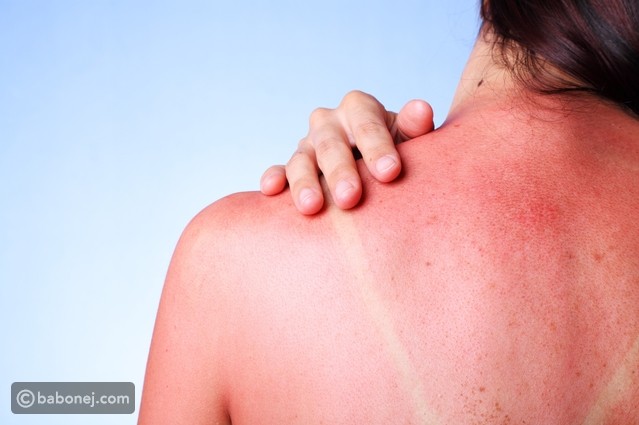 علاج حروق الشمس والوقاية منها