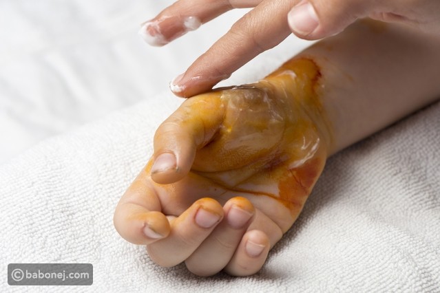 حروق الزيت درجاتها وطرق علاجها