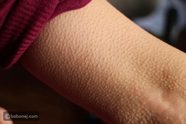 علاج جلد الوزة بطرق محتلفة وما هي أسبابه