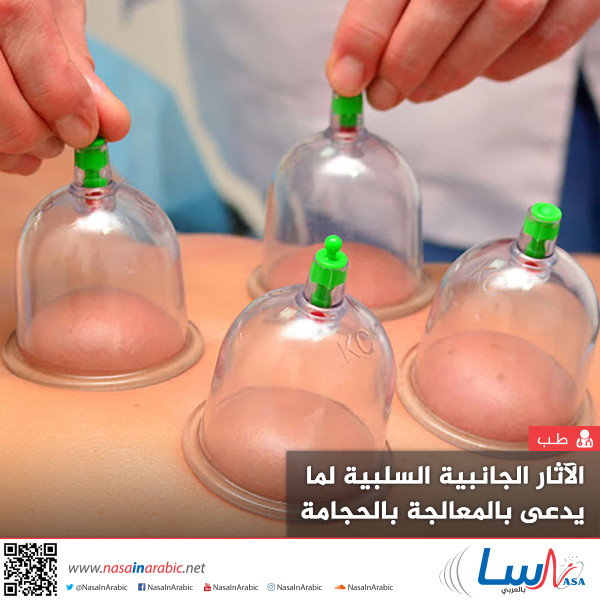 الآثار الجانبية السلبية لما يدعى بالمعالجة بالحجامة