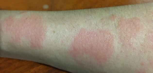 الاعراض الجلدية في الذئبة الحمراء