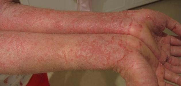 تشخيص مرض الزهري