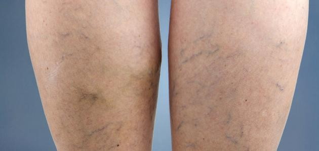 أسباب مرض دوالي الساقين