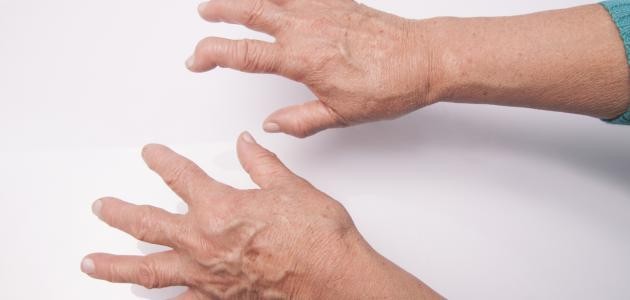 تشخيص الروماتيزم