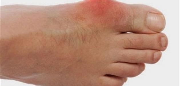 النقرس ومشاكل الكلى