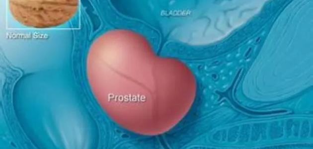 علاج مرض البروستاتا علاج مرض البروستاتا