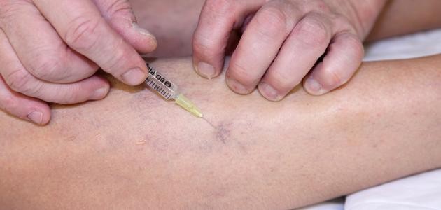 تشخيص دوالي الساقين