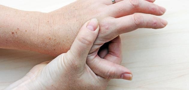 أعراض النقرس