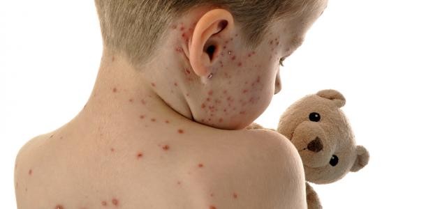 تشخيص مرض الحصبة