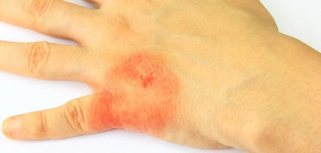 تشخيص مرض الجذام