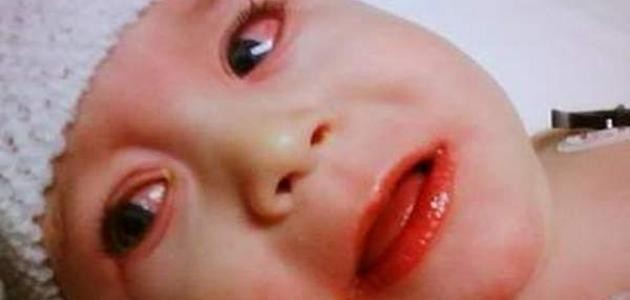 علاج مرض كاوازاكي