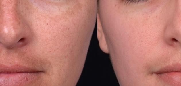 كيف أزيل الكلف نهائياً