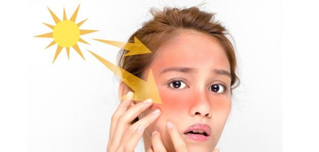 كيفية علاج حروق الشمس كيفية علاج حروق الشمس