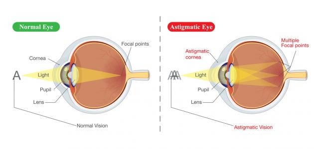 ما هو انحراف النظر