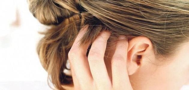 ما أسباب ألم فروة الراس