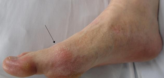 ما هو مرض النقرس