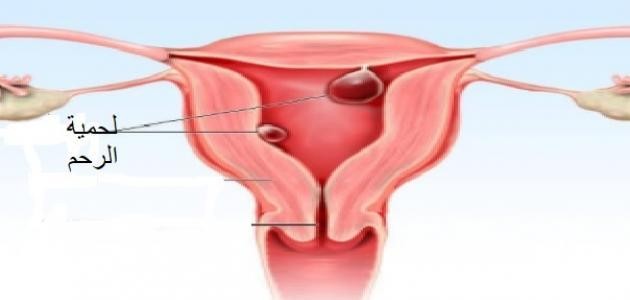 ما هي لحمية الرحم