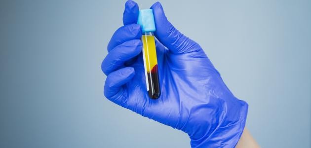 كيفية علاج نقص الصفائح الدموية